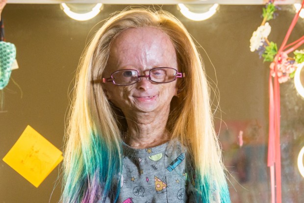 Adalia Rose Williams died at the age of 15 thumbnail